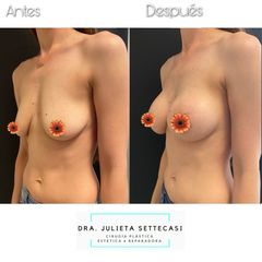 Aumento mamario - Dra. Julieta Settecasi