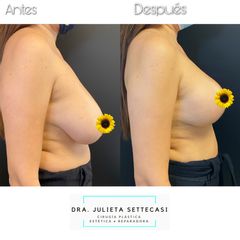 Reducción de mamas - Dra. Julieta Settecasi