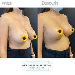 Reducción de mamas - Dra. Julieta Settecasi