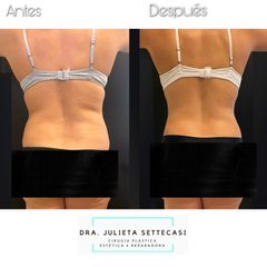 Dermolipectomía - Dra. Julieta Settecasi