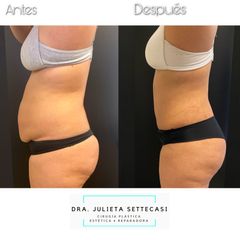 Dermolipectomía - Dra. Julieta Settecasi