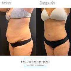 Dermolipectomía - Dra. Julieta Settecasi