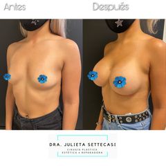 Aumento de mamas - Dra. Julieta Settecasi
