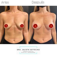 Aumento de mamas - Dra. Julieta Settecasi