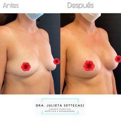 Aumento de mamas - Dra. Julieta Settecasi