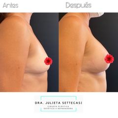 Aumento de mamas - Dra. Julieta Settecasi