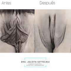 Labioplastia - Dra. Julieta Settecasi