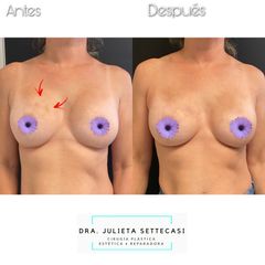 Recambio de Implantes - Dra. Settecasi