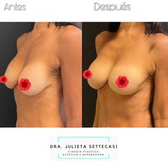 Recambio de Implantes - Dra. Julieta Settecasi