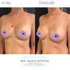 Recambio de Implantes - Dra. Julieta Settecasi