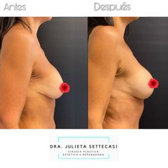 Recambio de implantes - Dra. Julieta Settecasi
