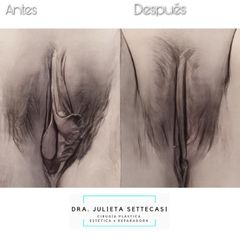 Labioplastia - Dra. Julieta Settecasi