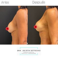 Recambio de implantes - Dra. Julieta Settecasi
