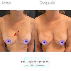 Recambio de Implantes - Dra. Julieta Settecasi