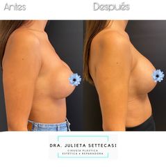 Recambio de Implantes - Dra. Julieta Settecasi