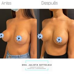 Recambio de Implantes - Dra. Julieta Settecasi