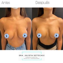 Recambio de Implantes - Dra. Julieta Settecasi.
