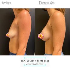 Aumento Mamas - Dra. Julieta Settecasi