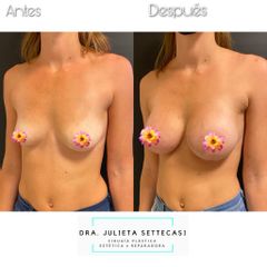 Aumento Mamas - Dra. Julieta Settecasi