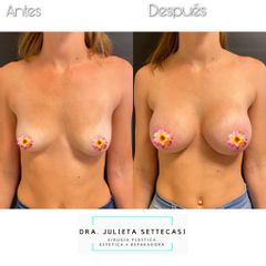 Aumento Mamas - Dra. Julieta Settecasi
