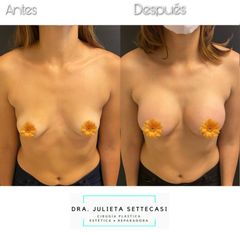 Aumento Mamas - Dra. Julieta Settecasi