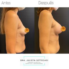 Aumento Mamas - Dra. Julieta Settecasi