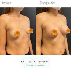 Aumento Mamas - Dra. Julieta Settecasi