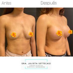 Aumento Mamas - Dra. Julieta Settecasi