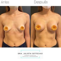 Aumento Mamas - Dra. Julieta Settecasi