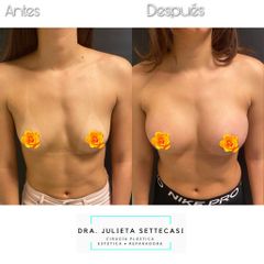 Aumento Mamas - Dra. Julieta Settecasi