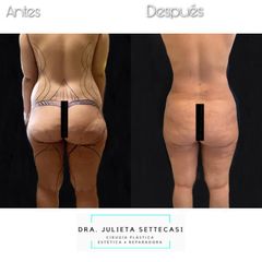 Liposucción ultrasónica - Dra. Julieta Settecasi