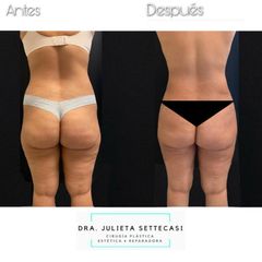 Liposucción HD - Dra. Julieta Settecasi