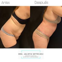 Abdominoplastia - Dra. Julieta Settecasi