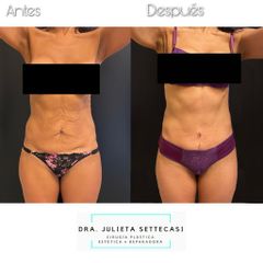 Abdominoplastia - Dra. Julieta Settecasi