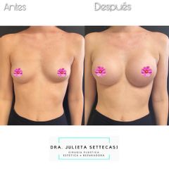 Aumento mamas  - Dra. Julieta Settecasi