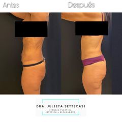 Abdominoplastia - Dra. Julieta Settecasi