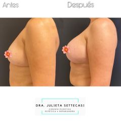 Aumento mamas  - Dra. Julieta Settecasi