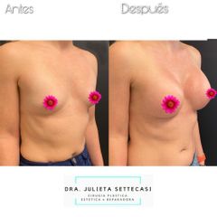 Aumento mamas  - Dra. Julieta Settecasi