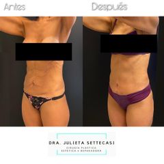 Abdominoplastia - Dra. Julieta Settecasi