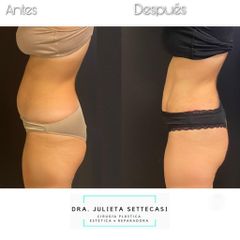 Minidermolipectomía - Dra. Julieta Settecasi