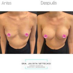 Aumento mamas  - Dra. Julieta Settecasi