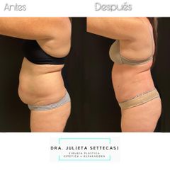 Abdominoplastia - Dra. Julieta Settecasi