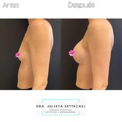 Aumento mamas  - Dra. Julieta Settecasi
