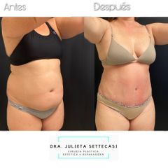 Abdominoplastia - Dra. Julieta Settecasi