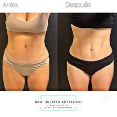 Minidermolipectomía - Dra. Julieta Settecasi
