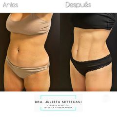 Minidermolipectomía - Dra. Julieta Settecasi