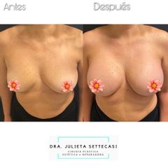 Aumento mamas - Dra. Julieta Settecasi
