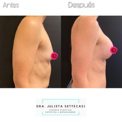 Aumento mamas  - Dra. Julieta Settecasi