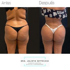 Liposucción HD + aumento glúteo - Dra. Julieta Settecasi