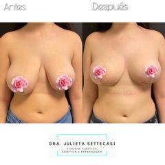 Reducción de mamas - Dra. Julieta Settecasi